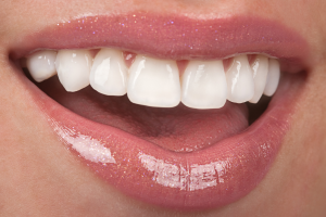 veneers